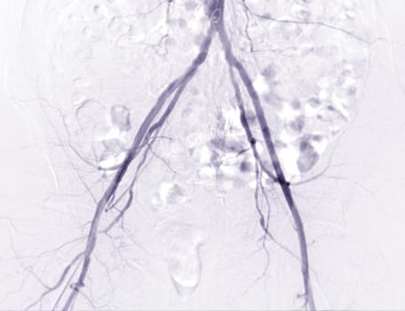 Femoral artery angiogram or angiography