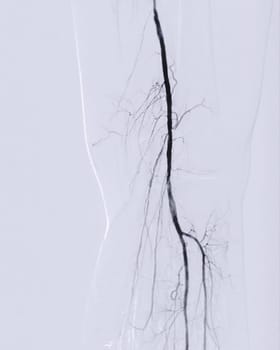 Femoral artery angiogram or angiography