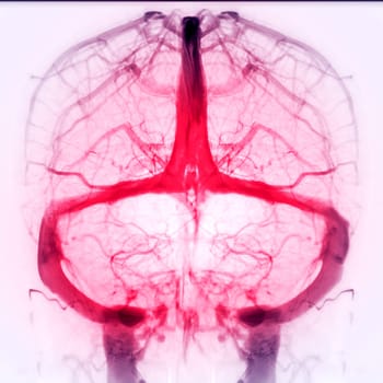 Cerebral Venograpgy for diagnosisi Cerebral Venous Thrombosis