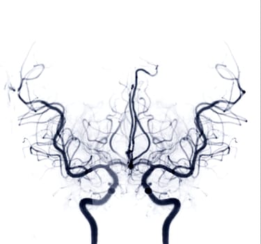 Cerebral angiography image from Fluoroscopy in intervention radiology showing cerebral artery.