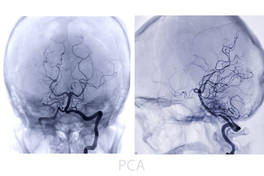 Cerebral angiography image from Fluoroscopy in intervention radiology showing cerebral artery.