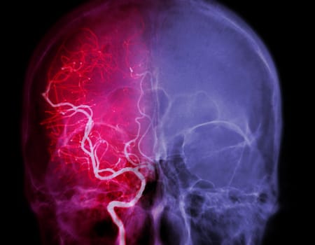 Cerebral angiography image from Fluoroscopy in intervention radiology showing cerebral artery.