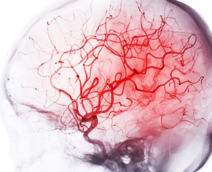 Cerebral angiography image from Fluoroscopy in intervention radiology showing cerebral artery.