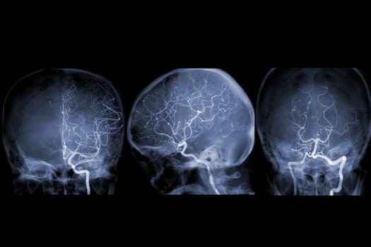 Cerebral angiography image from Fluoroscopy in intervention radiology showing cerebral artery.