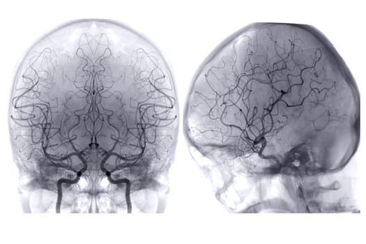 Cerebral angiography image from Fluoroscopy in intervention radiology showing cerebral artery.