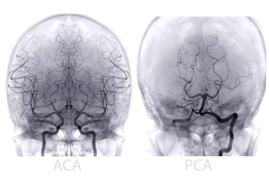 Cerebral angiography image from Fluoroscopy in intervention radiology showing cerebral artery.