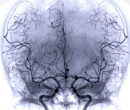 Cerebral angiography image from Fluoroscopy in intervention radiology showing cerebral artery.