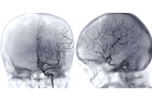 Cerebral angiography image from Fluoroscopy in intervention radiology showing cerebral artery.