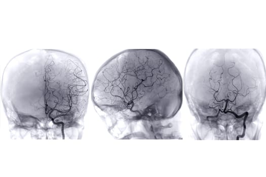 Cerebral angiography image from Fluoroscopy in intervention radiology showing cerebral artery.