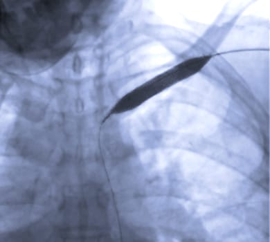 Image of Angioplasty, balloon angioplasty and percutaneous transluminal angioplasty (PTA) .