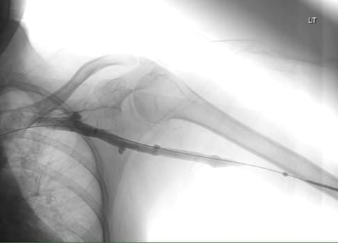 Image of Angioplasty, balloon angioplasty and percutaneous transluminal angioplasty (PTA) .