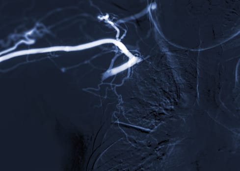 Image of Angioplasty, balloon angioplasty and percutaneous transluminal angioplasty (PTA) .