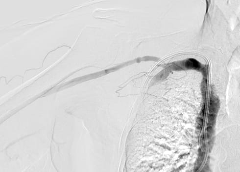 Image of Angioplasty, balloon angioplasty and percutaneous transluminal angioplasty (PTA) .