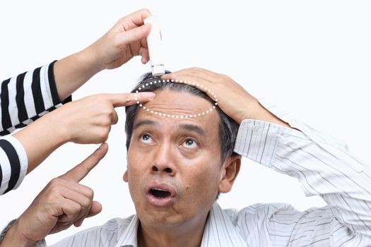 Baldness (hair loss) led to Mid-life Crisis