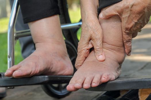 Elderly woman swollen feet press test on wheelchair