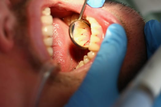 Dentist examines male teeth and inflamed gums with mirror. Examination of problematic teeth concept