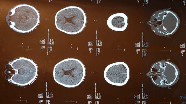 X-ray of the brain in case of head injury, stroke disease in an old adult. Magnetic resonance imaging, MRI close-up during examination by a doctor in a hospital. Examination by a neurologist, vertical