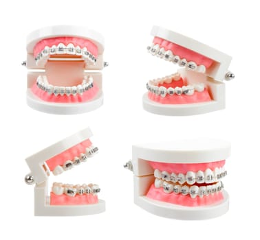 Set teeth model with metal wire dental braces or dental instruments isolated on white background, Save clipping path.