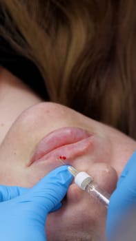 close-up, female face. Surgeon, in medical gloves, carefully and slowly injects hyaluronic acid into woman's lips with a syringe. lip augmentation procedure. beauty injections. Plastic surgery