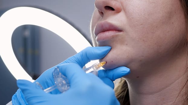 A doctor inserts painkillers into the chin area of womans face.