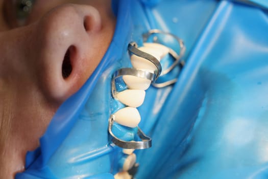 Patient at dentist office to install dentures or veneers closeup. Dental prosthetics concept