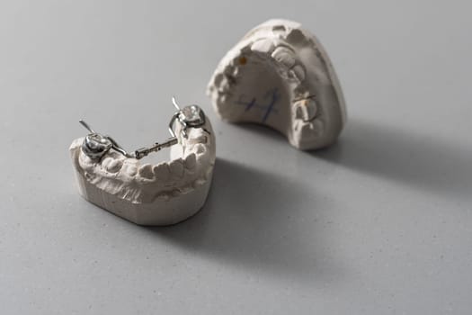 Dental casting gypsum model of human jaws. Crooked teeth and distal bite. Shots were made before treatment with braces . Technical shots on gray background.