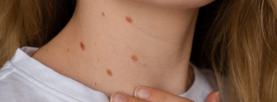 Unrecognizable woman showing her Birthmarks on neck skin Close up detail of the bare skin Sun Exposure effect on skin, Banner Health Effects of UV Radiation Woman with birthmarks Pigmentation and lot of birthmarks