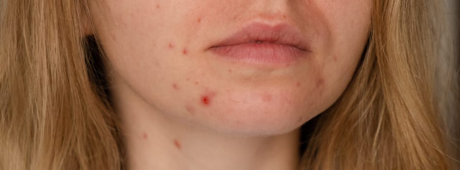 Unrecognizable woman showing her acne on face. Close-up acne on woman's face with rash skin ,scar and spot that allergic to cosmetics. Banner Problem skincare and health concept. Wrinkles, melasma, dark spots, freckles, dry skin, acne blackheads on face middle age women chin acne problem. pimples on the beard. problem skin in a young girl. hormonal misbalance. Skin disorders lead to depression and insecurities in women