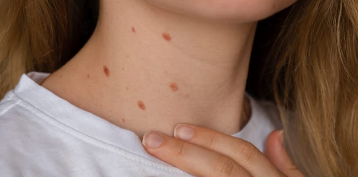 Unrecognizable woman showing her Birthmarks on neck skin Close up detail of the bare skin Sun Exposure effect on skin, Health Effects of UV Radiation Woman with birthmarks Pigmentation and lot of birthmarks