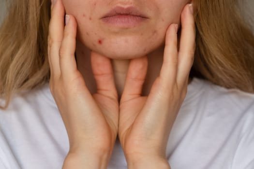 Unrecognizable woman showing her acne on face. Close-up acne on woman's face with rash skin ,scar and spot that allergic to cosmetics. Problem skincare and health concept. Wrinkles, melasma, dark spots, freckles, dry skin, acne blackheads on face middle age women chin acne problem. pimples on the beard. problem skin in a young girl. hormonal misbalance. Skin disorders lead to depression and insecurities in women