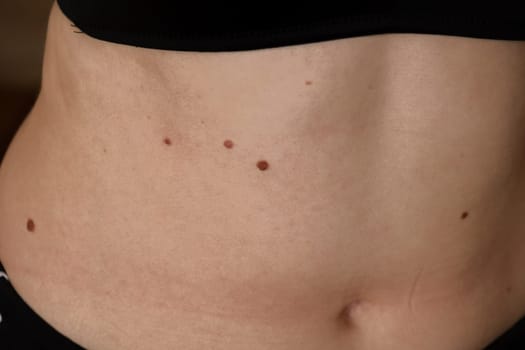 Unrecognizable woman showing her Birthmarks on skin Close up detail of the bare skin Sun Exposure effect on skin, Health Effects of UV Radiation Woman with birthmarks Pigmentation and lot of birthmarks