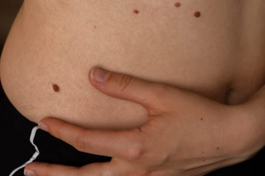 Unrecognizable woman showing her Birthmarks on skin Close up detail of the bare skin Sun Exposure effect on skin, Health Effects of UV Radiation Woman with birthmarks Pigmentation and lot of birthmarks