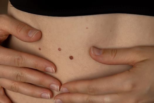 Unrecognizable woman showing her Birthmarks on skin Close up detail of the bare skin Sun Exposure effect on skin, Health Effects of UV Radiation Woman with birthmarks Pigmentation and lot of birthmarks