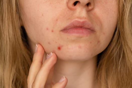 Unrecognizable woman showing her acne on face. Close-up acne on woman's face with rash skin ,scar and spot that allergic to cosmetics. Problem skincare and health concept. Wrinkles, melasma, dark spots, freckles, dry skin, acne blackheads on face middle age women chin acne problem. pimples on the beard. problem skin in a young girl. hormonal misbalance. Skin disorders lead to depression and insecurities in women