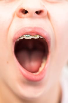 Close-up of the mouth of a girl with rainbow braces.