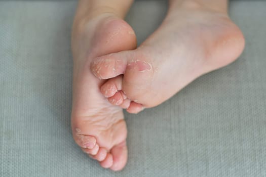 Enterovirus foot hand mouth Skin peeled off on the legs of a child Cocksackie virus