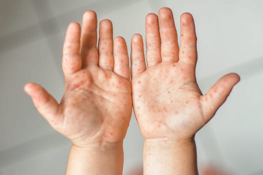 Enterovirus Legs hands mouth Rash on the body of a child Cocksackie virus
