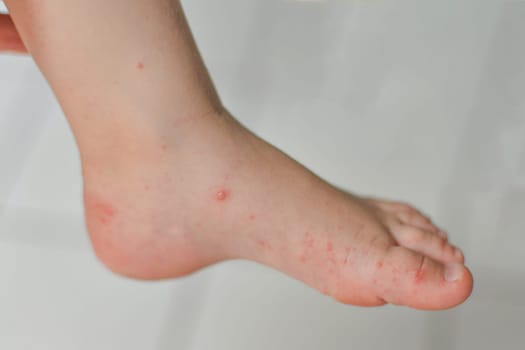 Enterovirus Legs hands mouth Rash on the body of a child Cocksackie virus