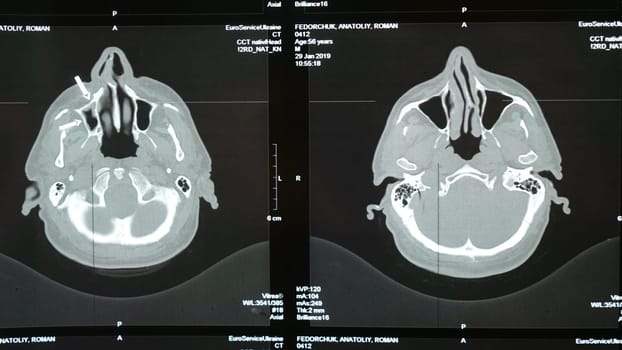 Magnetic resonance imaging of an older man's brain after a traumatic brain injury, which shows that the brain is damaged. Tomographic image of the head. Examination by a neurologist