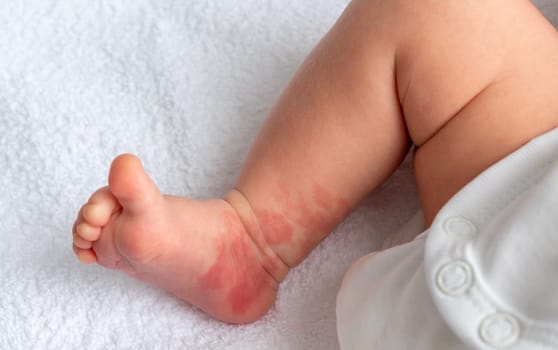 Infant Hemangioma red birthmark on the leg of newborn baby
