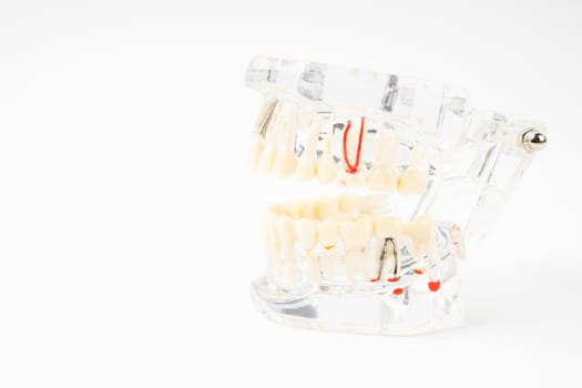 Dentures model, abutment and human teeth and dentures on white background.