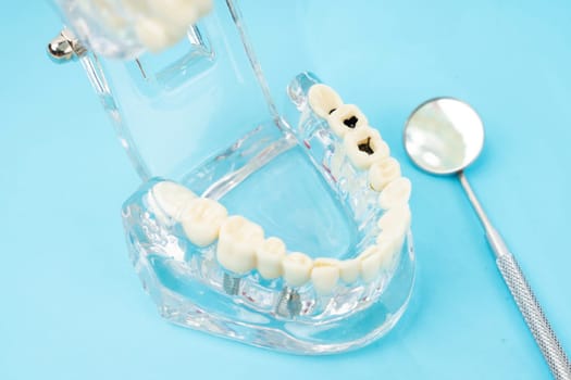 Healthy and decayed teeth model and mouth mirror, Dental concepts.