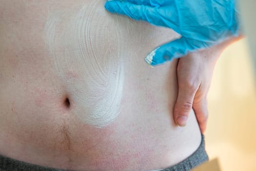 A nurse smears a body covered with an allergic rash to a patient.The hands of a doctor smear a person's skin with a white ointment.