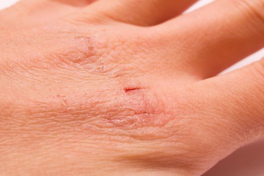 Scars on the hand on a white background