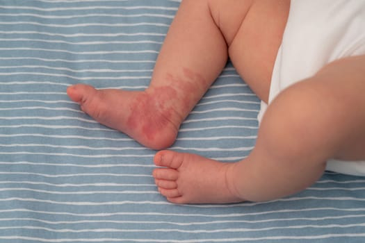 Infant Hemangioma red birthmark on the leg of newborn baby