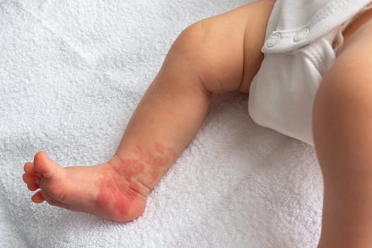 Infant Hemangioma red birthmark on the leg of newborn baby