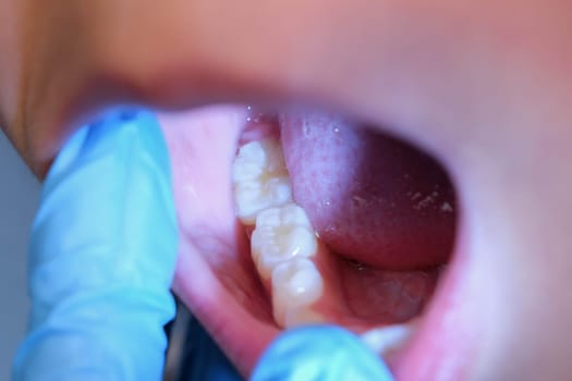 Close-up inside the oral cavity of a healthy child with beautiful rows of baby teeth. Young girl opens mouth revealing upper and lower teeth, hard palate, soft palate, dental and oral health checkup.