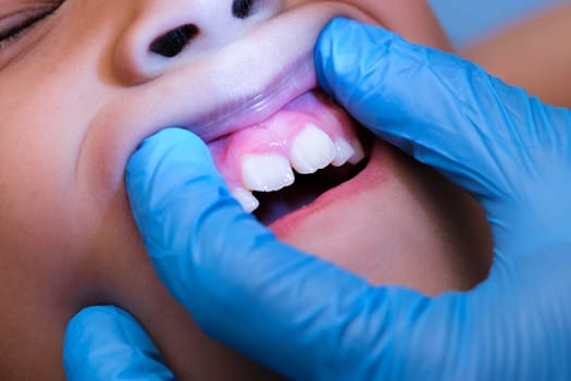 Close-up inside the oral cavity of a healthy child with beautiful rows of baby teeth. Young girl opens mouth revealing upper and lower teeth, hard palate, soft palate, dental and oral health checkup.