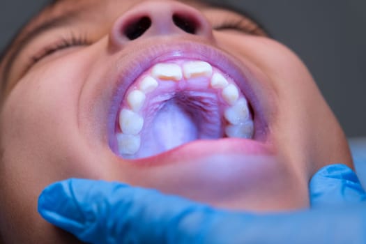 Close-up inside the oral cavity of a healthy child with beautiful rows of baby teeth. Young girl opens mouth revealing upper and lower teeth, hard palate, soft palate, dental and oral health checkup.