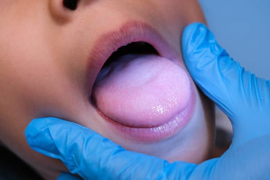 Close-up inside the oral cavity of a healthy child with beautiful rows of baby teeth. Young girl opens mouth revealing upper and lower teeth, hard palate, soft palate, dental and oral health checkup.